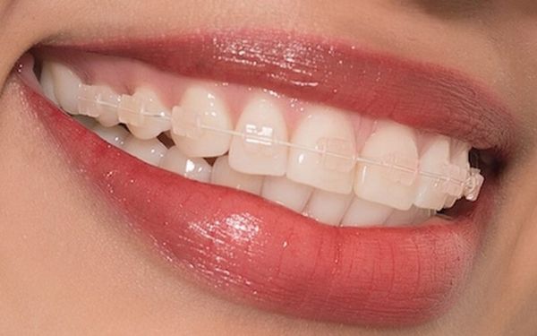 bị mất răng hàm có niềng được không?
