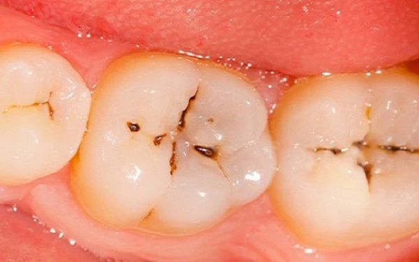 Những phương pháp chữa sâu răng nhẹ hiệu quả - Nha Khoa