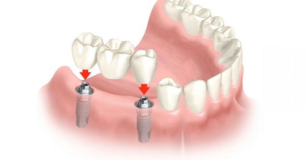trồng răng implant giá rẻ