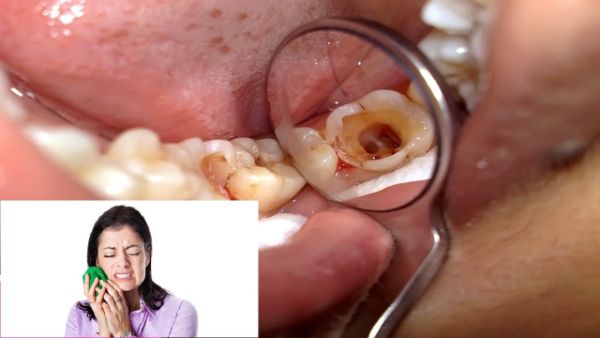 cách trị nhức răng sau khi trám