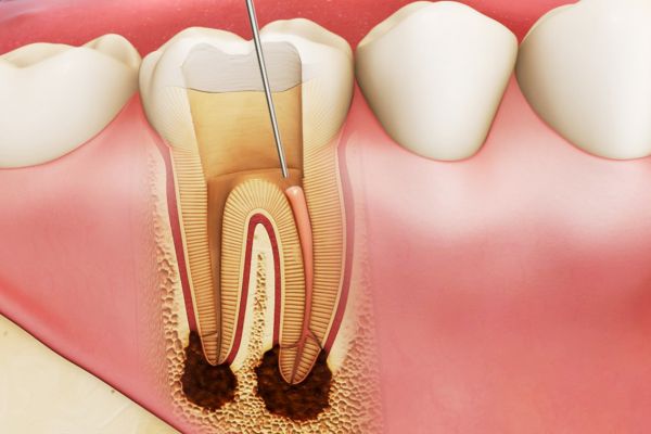 cách trị nhức răng sau khi trám
