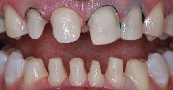 quy trình bọc răng sứ