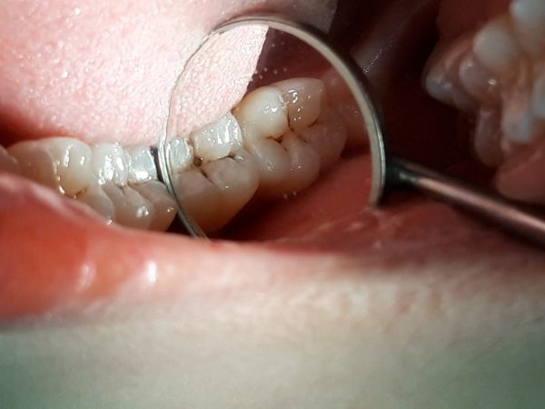 cách chữa sâu kẽ răng tại nhà