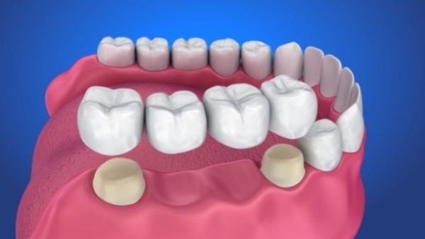 cách trồng răng