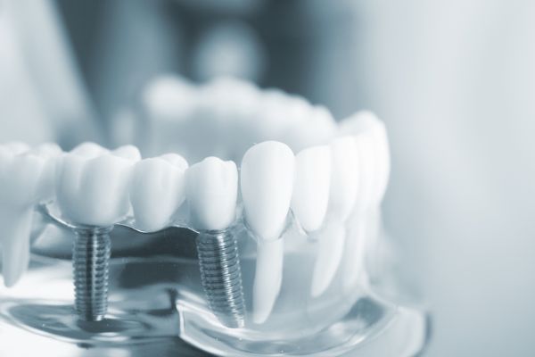 trồng răng implant có bị hôi miệng không