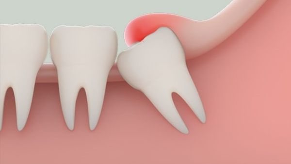 cách giảm đau răng khôn