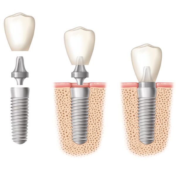 phương pháp trồng răng implant