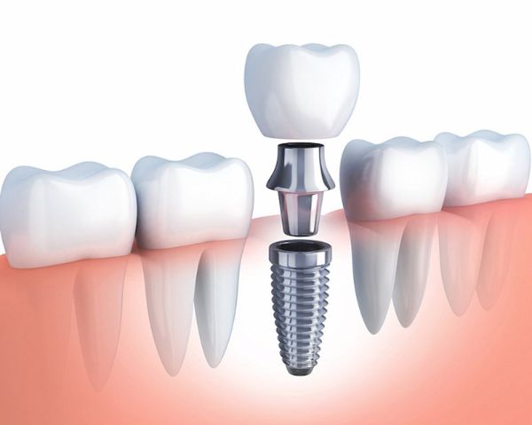 trồng răng implant ở đâu tốt