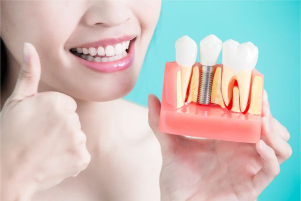 trồng răng implant ở đâu tốt