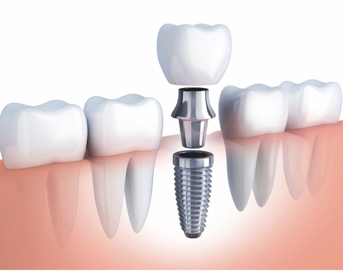 Răng implant được cấy ghép
