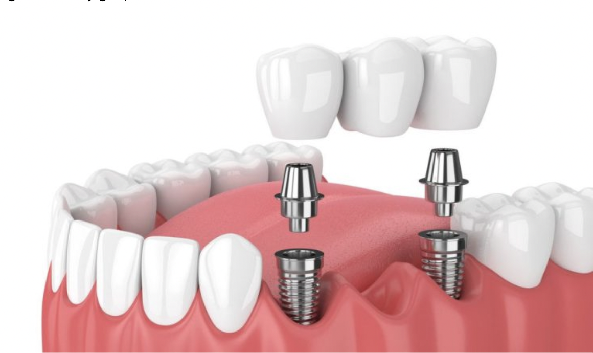 Phẫu thuật cấy ghép răng implant như thế nào?