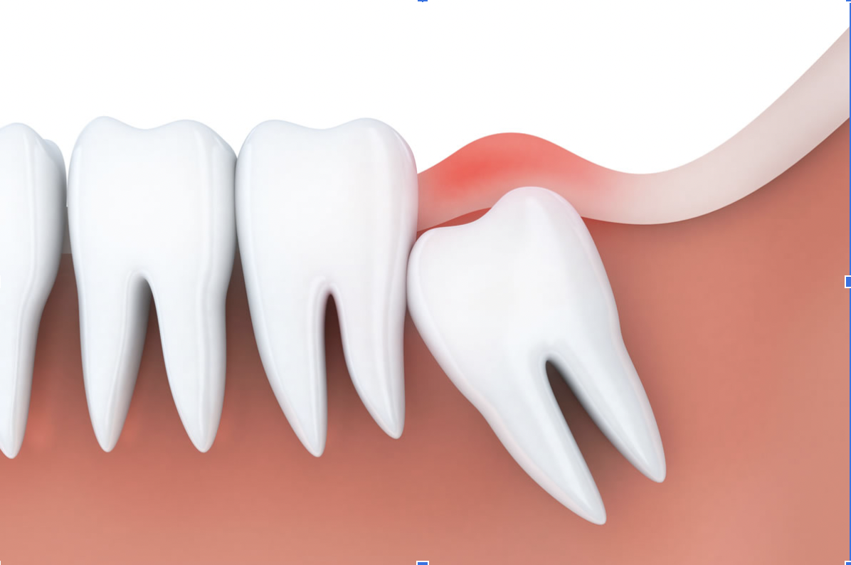 Những chiếc răng khôn mọc lệch có thể gây đau và khó giữ sạch