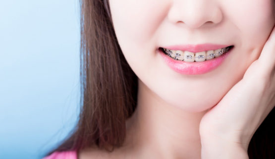 Niềng răng để tự tin mỉm cười thường xuyên hơn