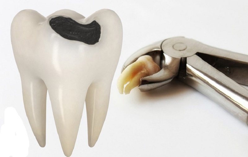 Có nhiều nguyên nhân khiến răng khôn bị sâu vỡ