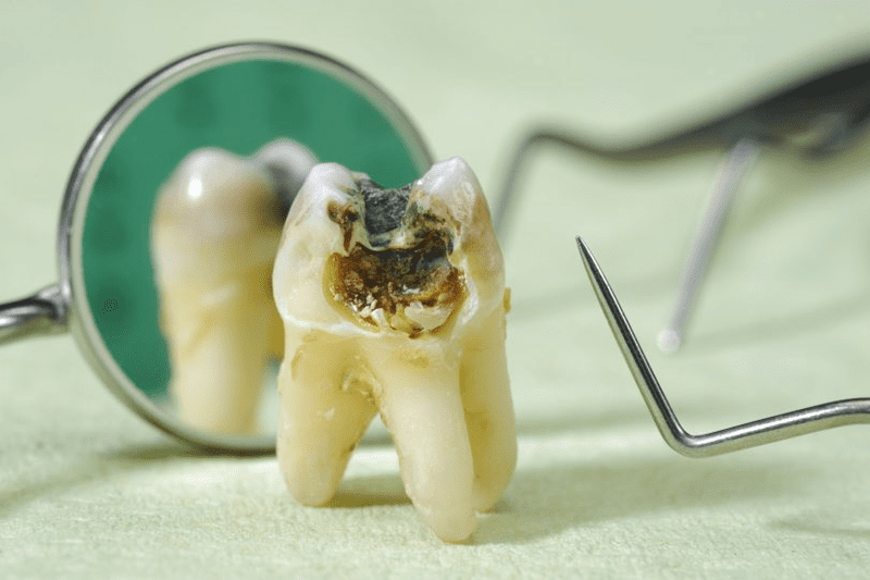 Vỡ răng do sâu răng