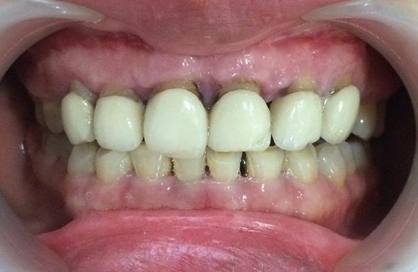 răng sứ sỉn màu do chấn thương tạo nên