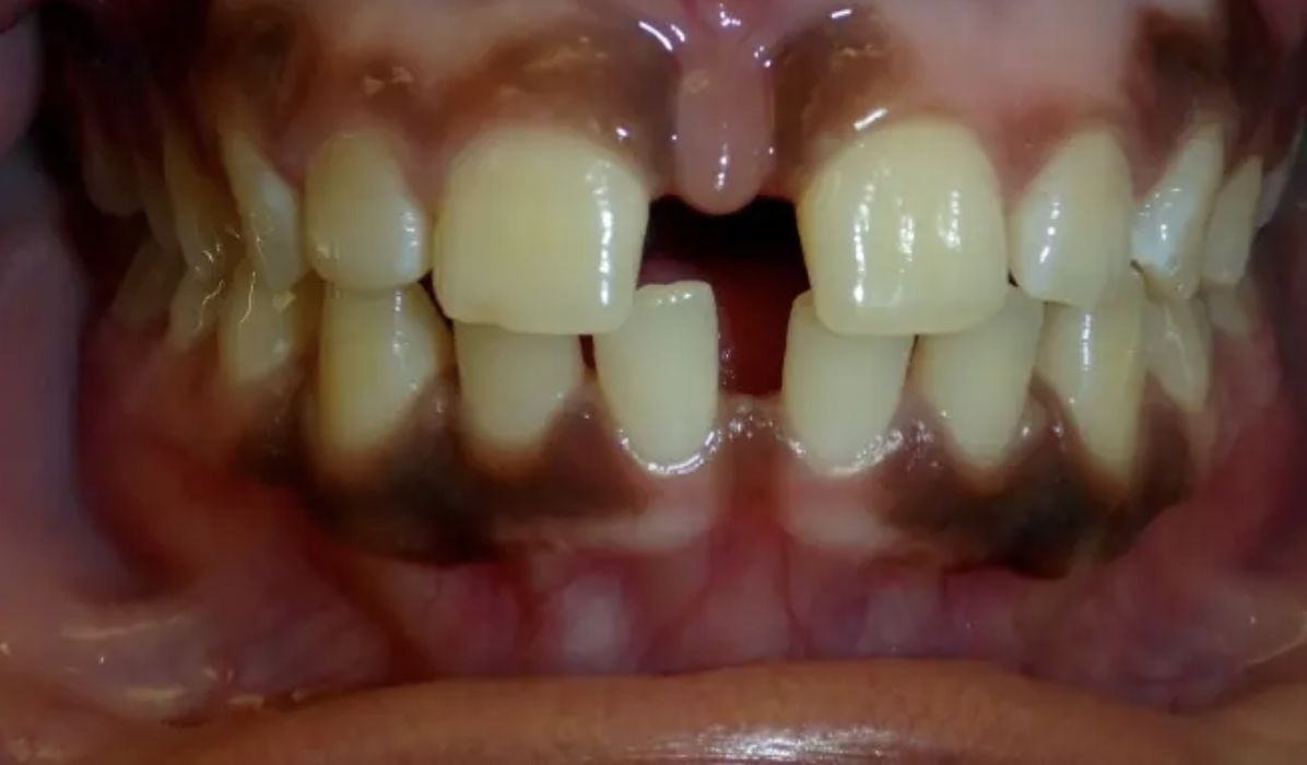Hình 1 - phẫu thuật cắt lợi sau niềng răng 