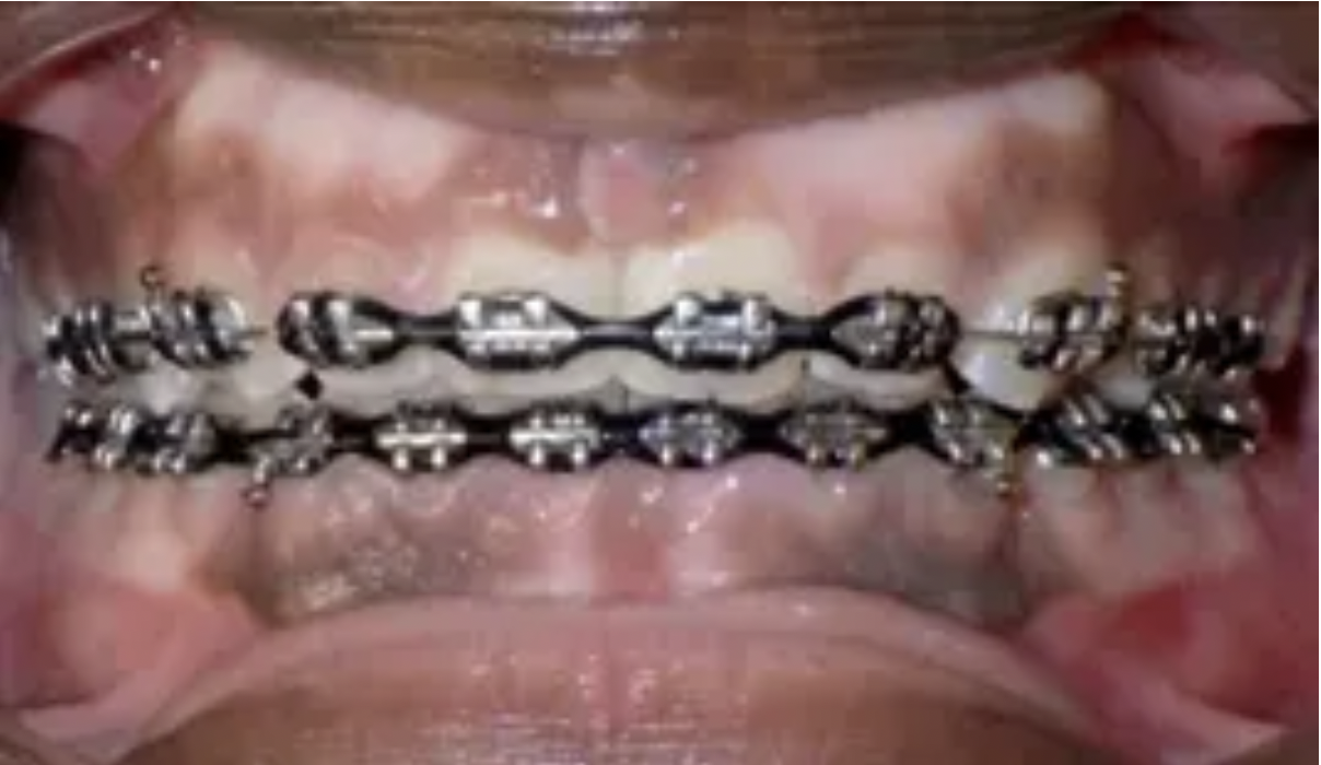 Hình 2 - phẫu thuật cắt lợi sau niềng răng 
