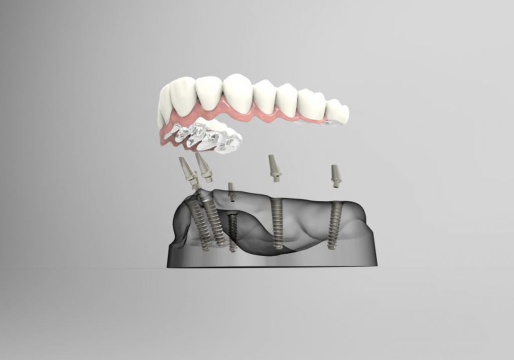 Có thể cấy ghép răng Implant liền kề nhau không?