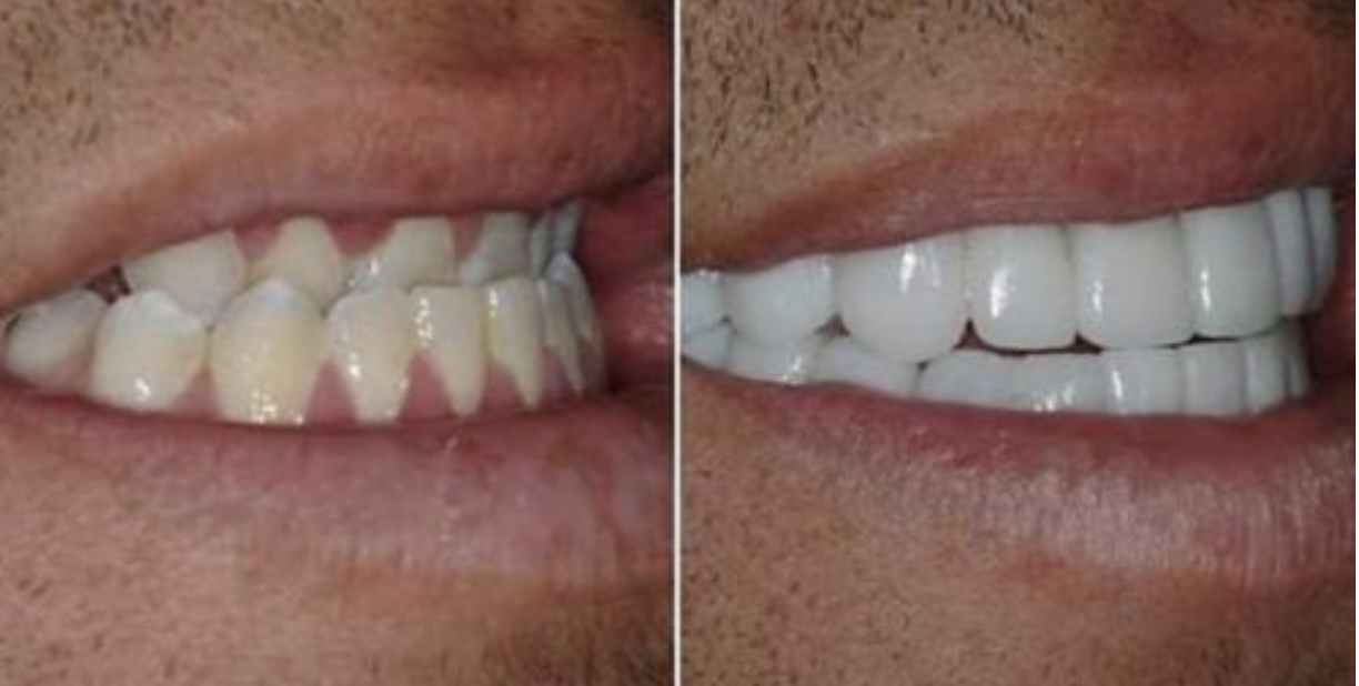Bọc răng sứ khắc phục răng móm