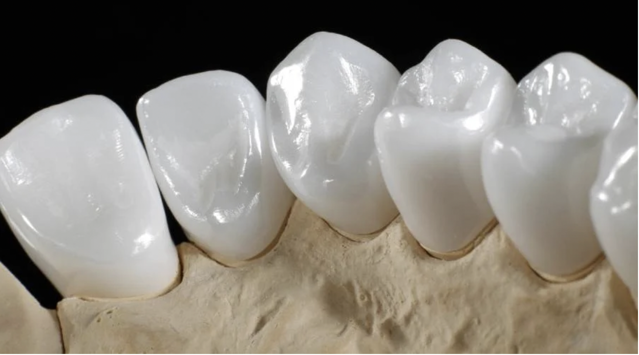 Bọc răng sứ Emax cho răng có cấu trúc, hình dạng khác thường