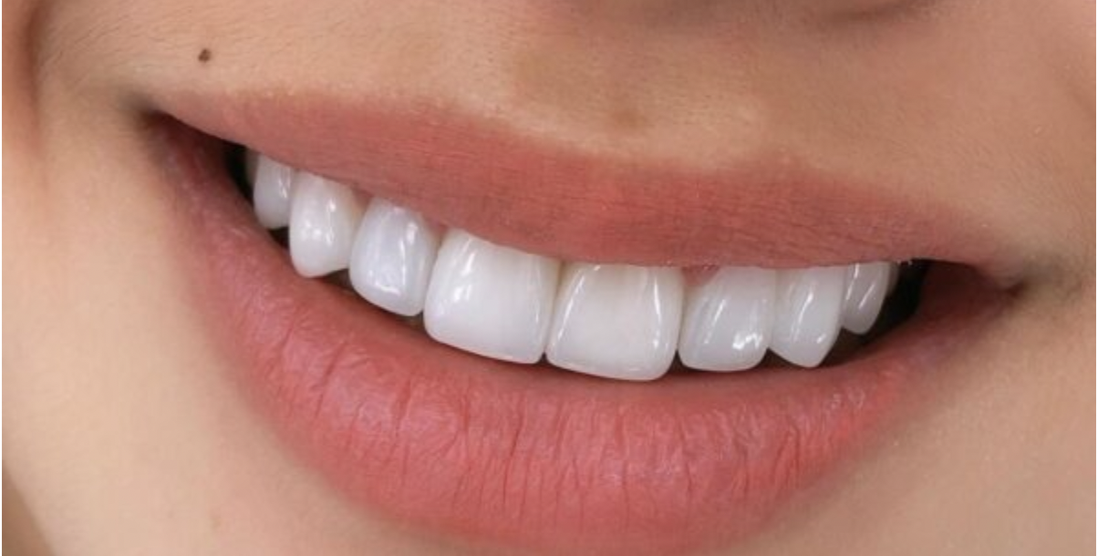 Bọc răng sứ có bền không phụ thuộc vào nhiều yếu tố