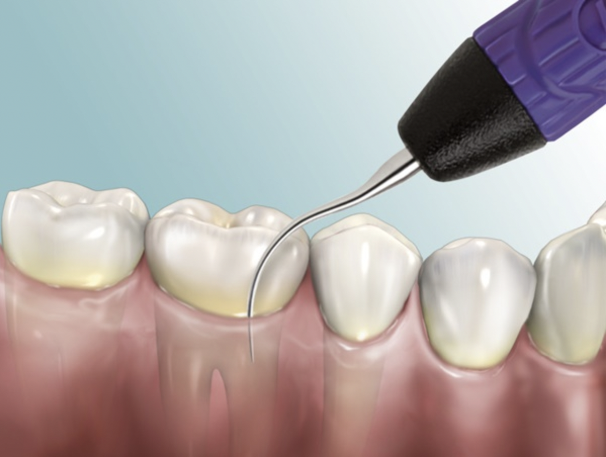 Phương  pháp lấy cao răng siêu âm