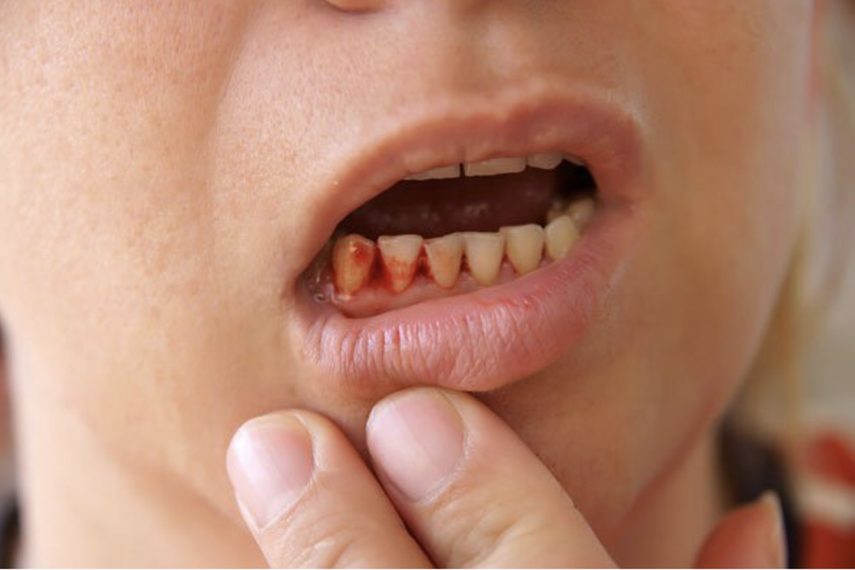Bệnh hôi miệng chảy máu chân răng được hiểu là các khu vực xung quanh răng bị tổn thương