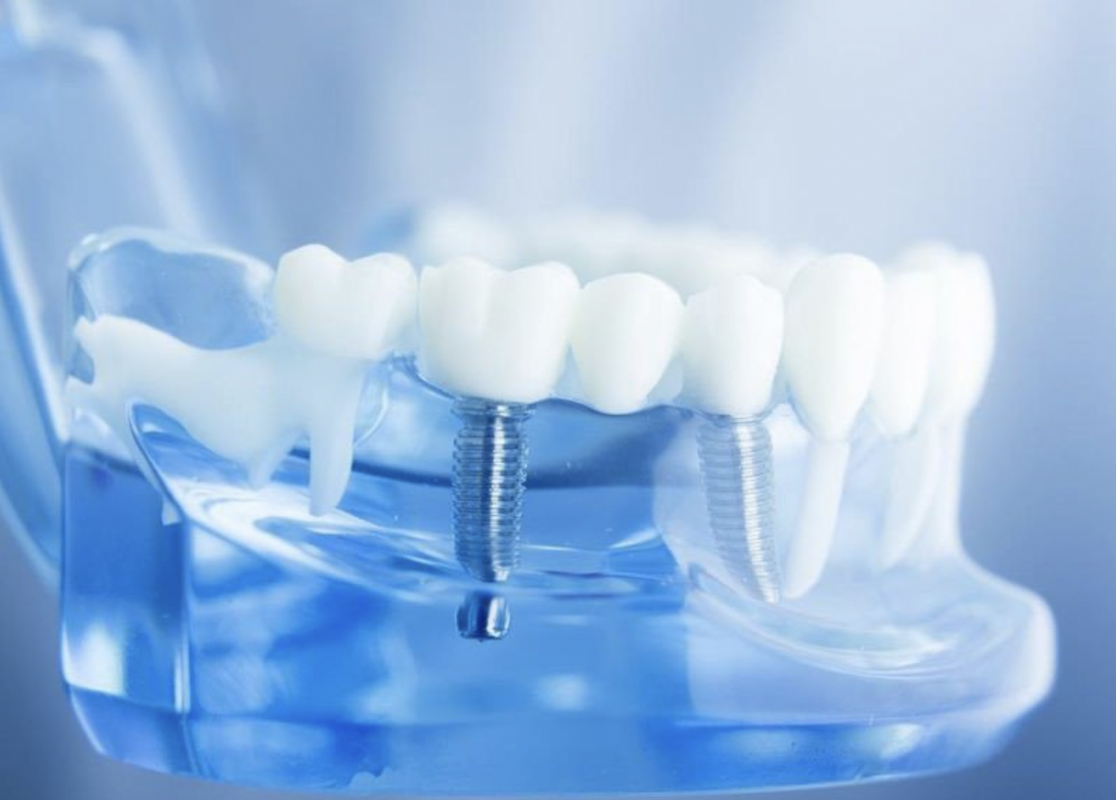 Chăm sóc răng đúng cách sau cấy ghép implant