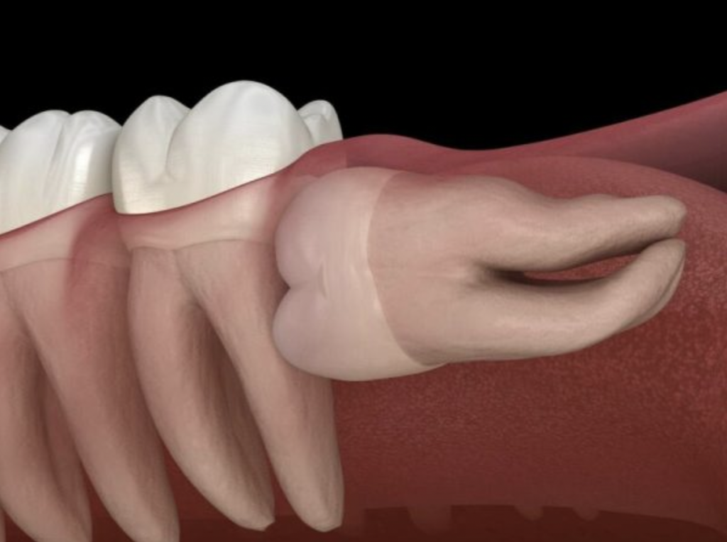 Răng mọc ngầm chính là răng nằm sâu bên trong xương hàm hoặc ngay dưới nướu