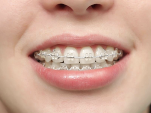 Bọc răng sứ xong vẫn có thể niềng răng