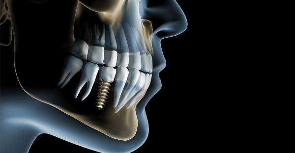 Làm sao để chúng ta biết liệu bao nhiêu tuổi được cắm implant là tốt nhất?