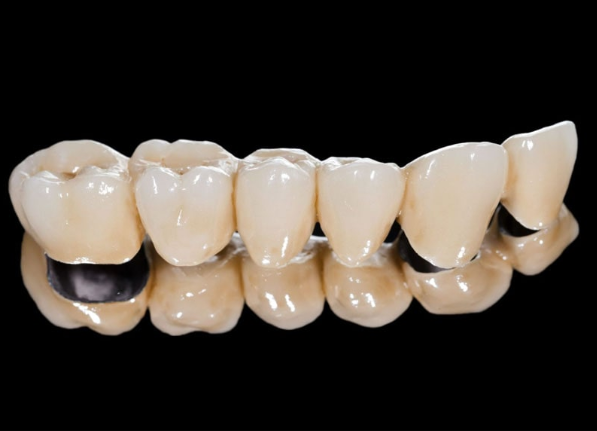 Ưu điểm, nhược điểm của răng sứ kim loại là gì?