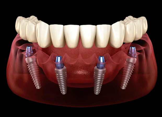 Kỹ thuật cấy ghép implant toàn hàm hay còn được gọi là Implant All On