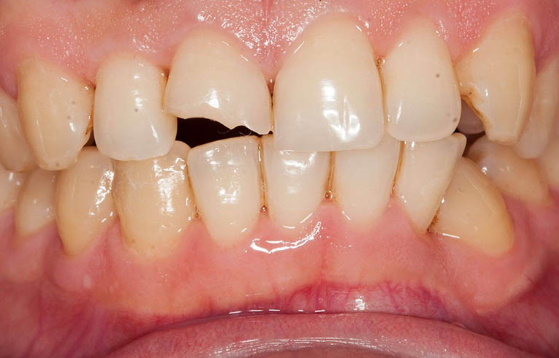Một trong những nguyên nhân gây nên tình trạng răng bị vỡ lớn là do thiếu hụt canxi