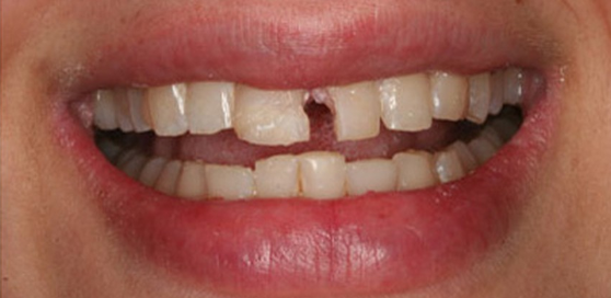 Nếu răng của bạn đang gặp tình trạng bể lớn hoặc thậm chí gãy ngang thì bọc răng sứ chính là giải pháp vô cùng phù hợp