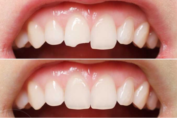 Bọc răng sứ cho răng vỡ giúp hàm răng chắc khỏe, khôi phục được chức năng ăn nhai