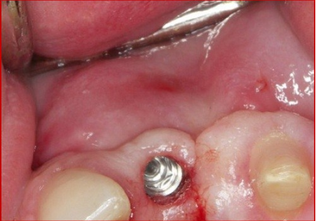 Máu chảy không ngừng sau khi cắm implant