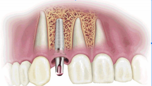 Răng implant tích hợp với xương hàm