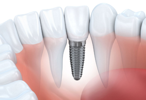 Trồng răng implant không gây đau đớn