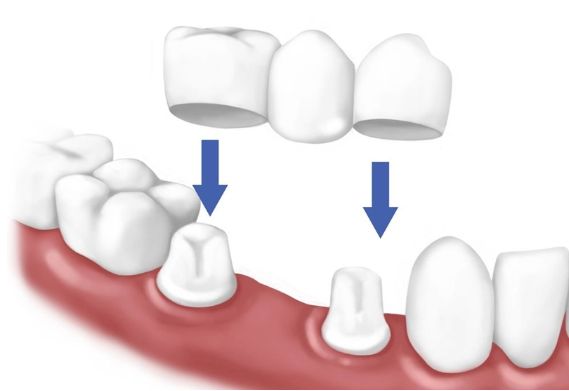 Kỹ thuật cầu răng sứ chính là giải pháp phục hình một hoặc nhiều răng đã mất phổ biến hiện nay
