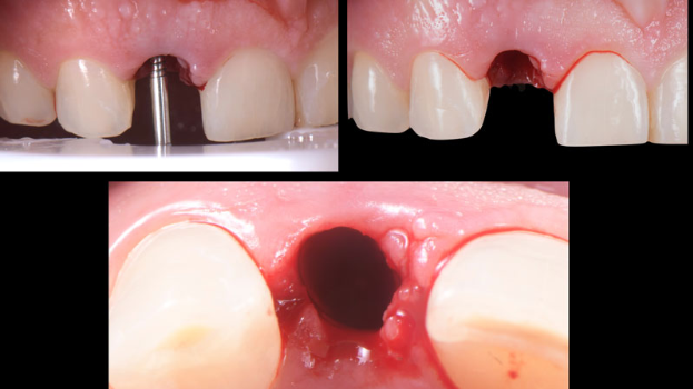 Tiến hành đặt implant ngay lúc nhổ răng