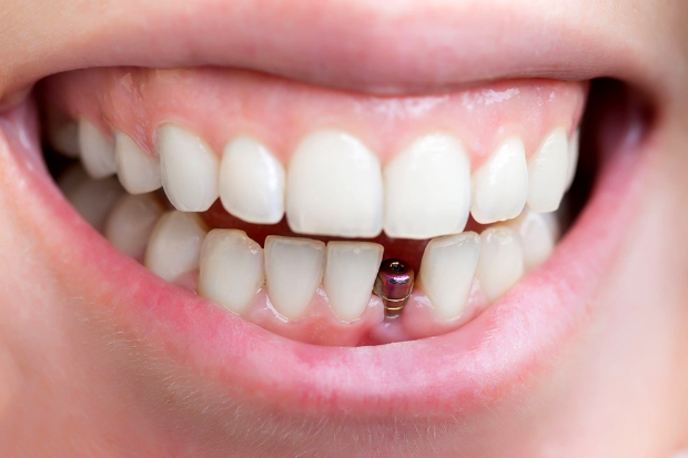 Đặt implant sau khi nhổ răng từ 1 – 3 tháng